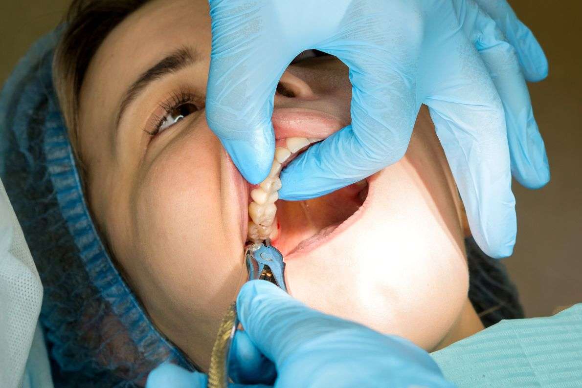 What Happens If You Delay a Necessary Surgical Extraction?