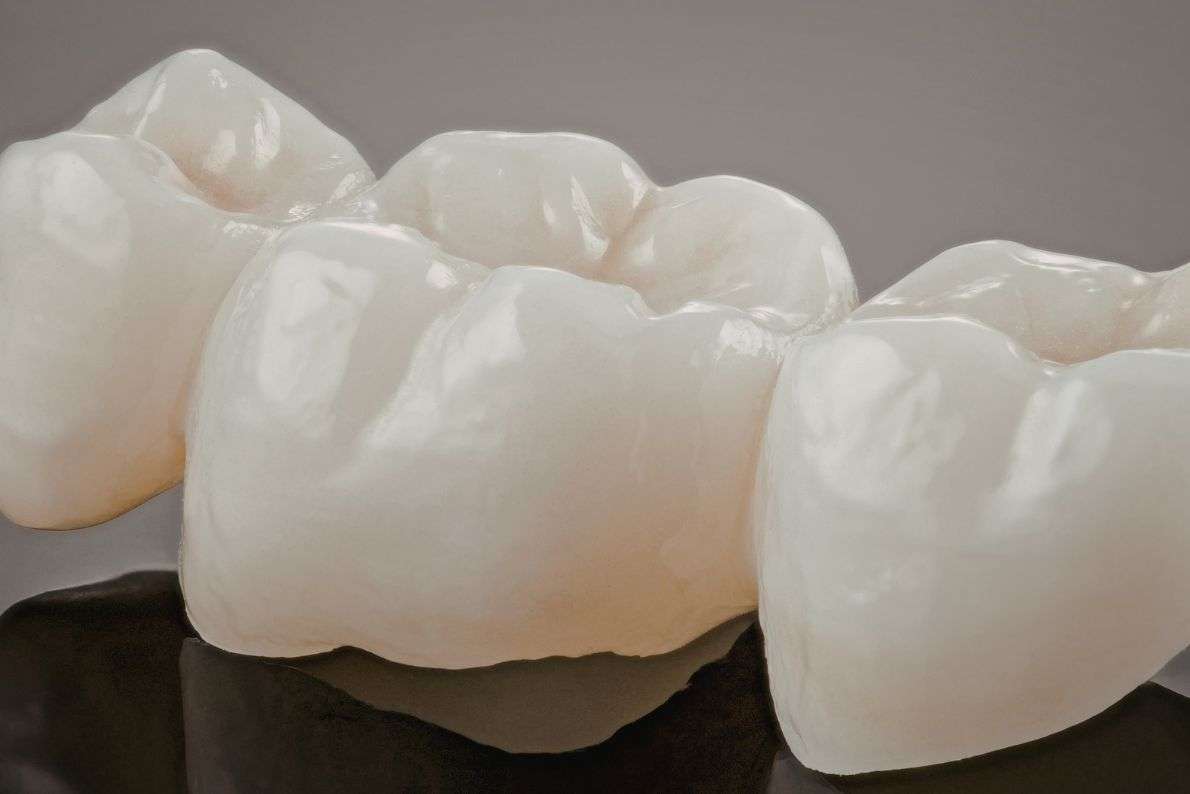 What Is a Dental Crown and When Do You Need One?