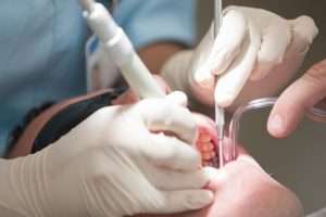What to Expect After a Scale and Polish Treatment