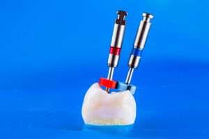 Why Delaying Root Canal Treatment Can Lead to More Serious Problems