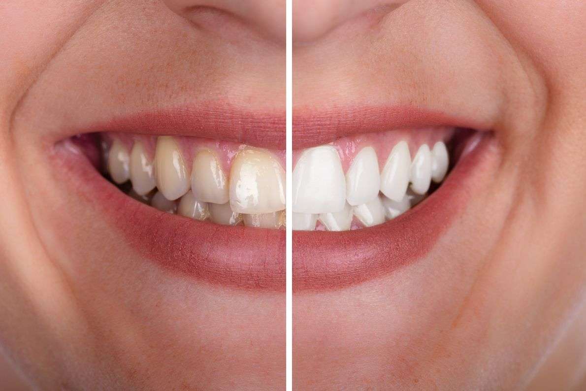 Why Take-Home Whitening Delivers Professional Results?