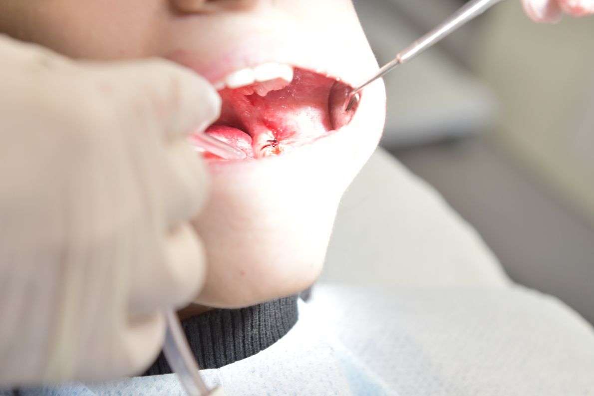 Why White Composite Fillings Are Popular Today