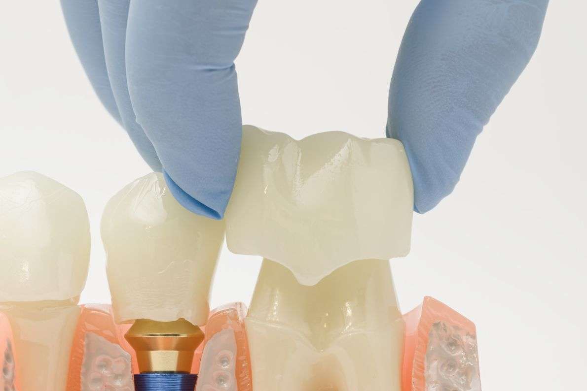 Why a Dental Crown Is Suitable for a Heavily Decayed Tooth